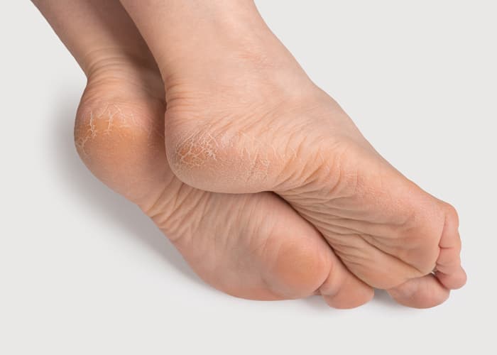 Cracked heels